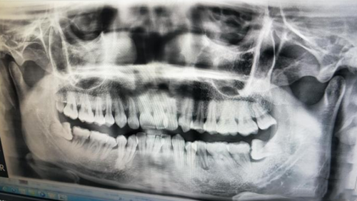 牙根短能矫正牙吗？做完牙齿矫正后会脱落 是正畸失败吗？
