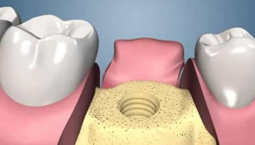 种植牙哪个步骤最痛苦？告知大家种植牙的步骤及时间