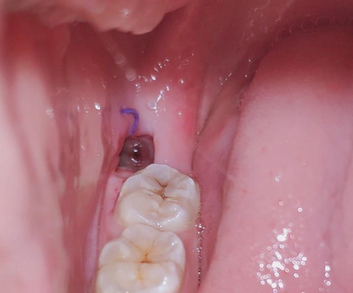 干槽症早期症状有哪些有图吗？上海浦东新区哪些牙科能治