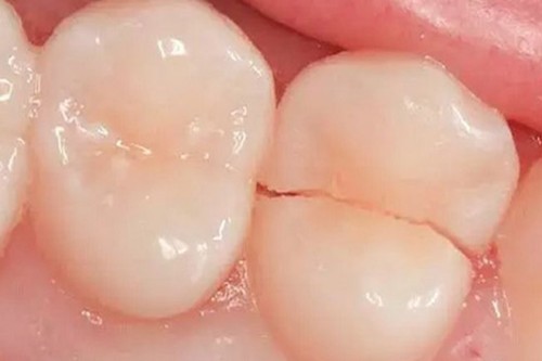 牙齿从中间裂开了怎么办？牙齿裂开修复价格是多少？