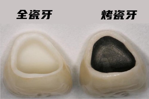 广州烤瓷牙与全瓷牙的价格分别是多少？公布广州牙冠的价格表