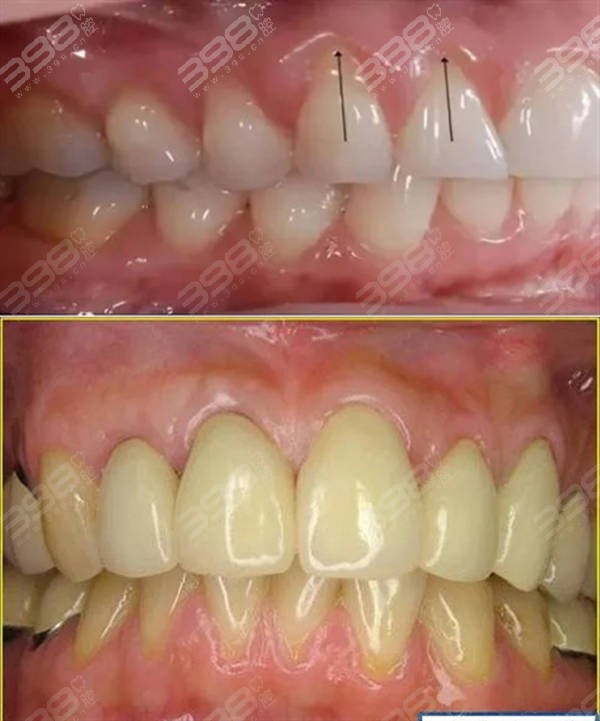 牙龈萎缩和正常牙龈图片对比看看你的牙龈还有救吗