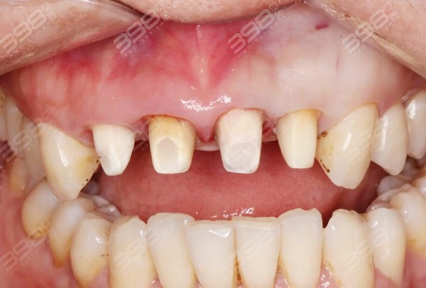 门牙缝隙大的补救方法及价格表附带补牙缝过程图解