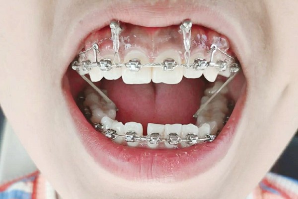 儿童金属自锁牙齿矫正多少钱?国产和进口托槽价格相差几千元