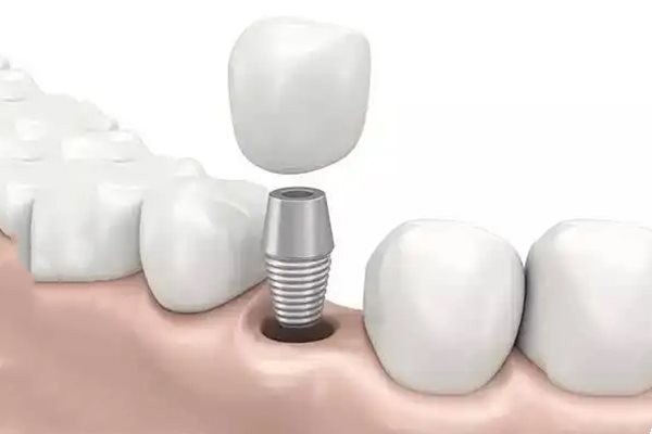 2023厦门正规的种植牙医院排名前十：麦芽/登特口腔种牙技术值得认可