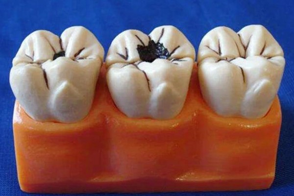 有蛀牙医生说洞太小补不了,这是真的吗?小黑点轻微蛀牙要补吗?