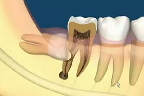为什么牙医建议尽量不拔智齿？不疼可以不拔吗？