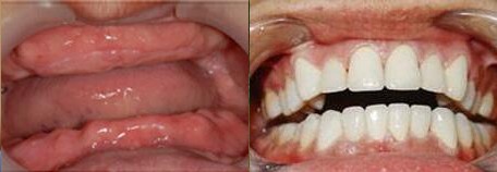 北京中诺口腔医院刘忠祥全口牙种植案例前后对比效果图