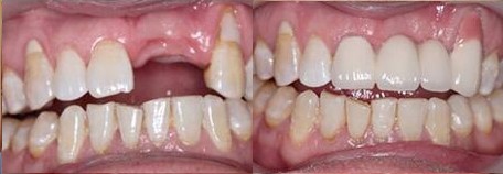 北京中诺口腔医院刘诚成单颗牙齿种植案例对比图
