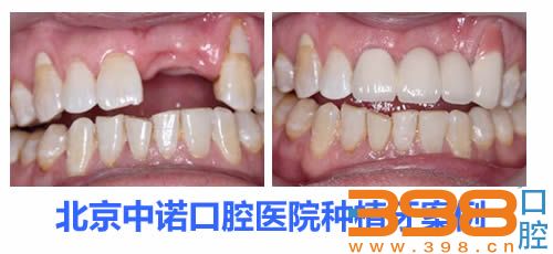 北京中诺口腔医院种植牙前后对比案例图片
