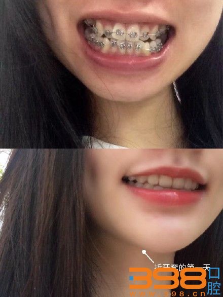 深圳22岁龅牙金属整牙案例