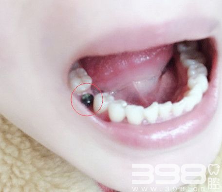 广州雅度口腔种植牙案例
