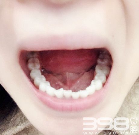 广州雅度口腔种植牙案例