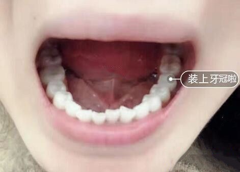 在成都团圆口腔当天拔牙当天种牙是一种什么体验？