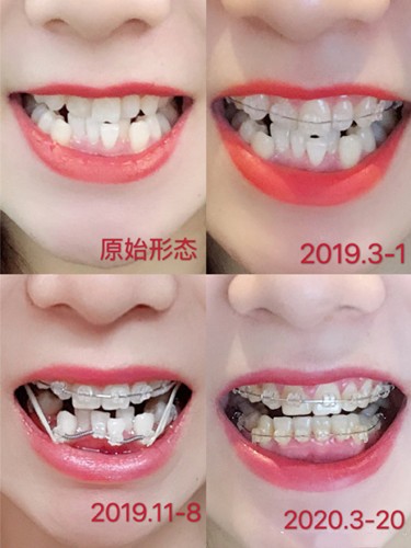 广州柏德口腔陶瓷半隐形牙齿矫正案例