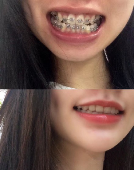 成年人龅牙可以矫正吗?22岁龅牙金属整牙案例