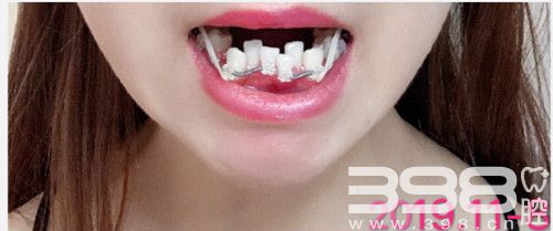 广州柏德口腔牙齿矫正案例
