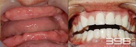 北京中诺口腔医院刘忠祥全口牙种植案例前后对比效果图