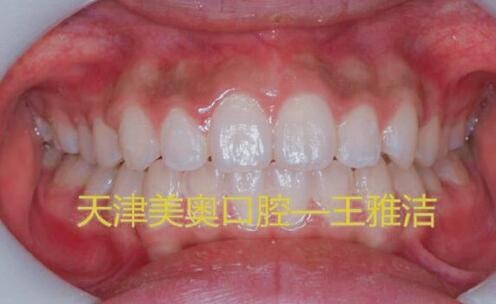 天津美奥口腔医院牙齿矫正对比案例图