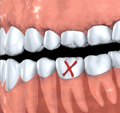 缺失牙齿的危害有哪些