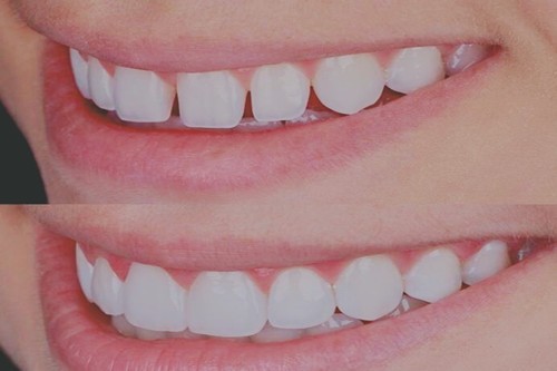 郑州美奥口腔医院牙齿瓷贴面前后对比案例
