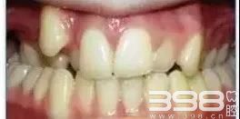 教你分辨龅牙、嘴凸、歪脸，是“牙性”还是“骨性”？   