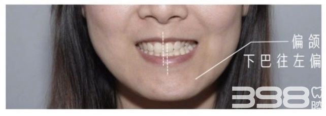 教你分辨龅牙、嘴凸、歪脸，是牙性还是骨性？