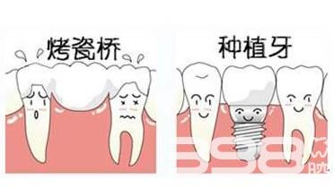 牙齿搭桥和种植哪个好，选择哪种牙齿修复方式更健康？