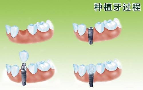年轻人镶什么牙最实用？北京口腔医院牙齿修复多少钱？