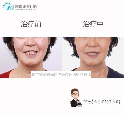 北京赛德阳光口腔医院牙齿矫正对比图