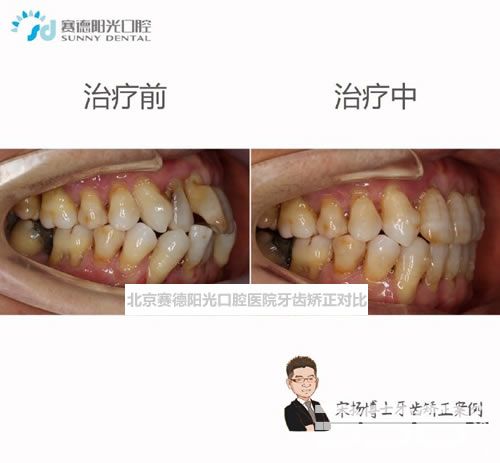 北京赛德阳光口腔医院牙齿矫正对比图