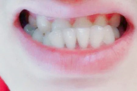 牙齿矫正君：怎么判断自己是牙性地包天还是骨性地包天？