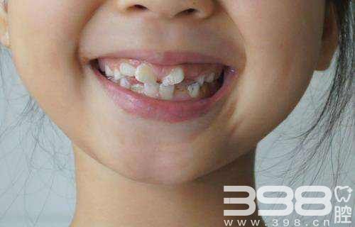 儿童牙齿矫正需要注意什么