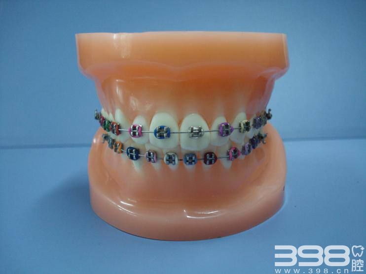 牙齿矫正中陶瓷自锁和非自锁有什么区别？各有什么优势？