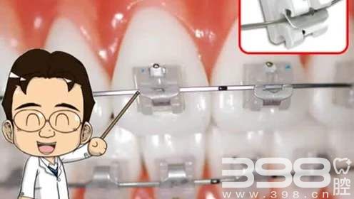 牙齿矫正中陶瓷自锁和非自锁有什么区别？各有什么优势？
