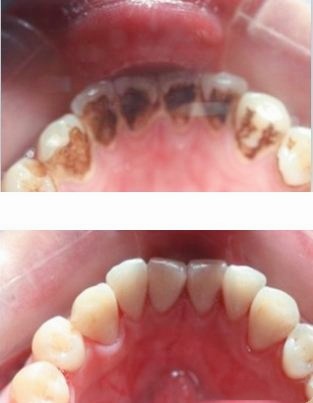 安庆朱小龙口腔医院用事实告诉你：洗牙对牙齿有没有伤害