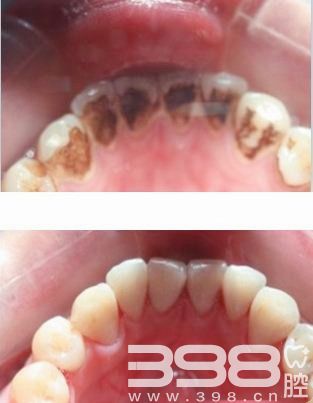安庆朱小龙口腔医院用事实告诉你：洗牙对牙齿有没有伤害