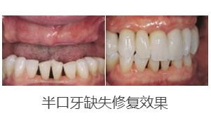 北京中诺口腔医院可以用医保吗？求种植牙价格表