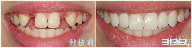 广州圣贝口腔种植牙案例
