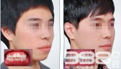 北京私立口腔医院前十位的壹加壹口腔牙齿矫正案例