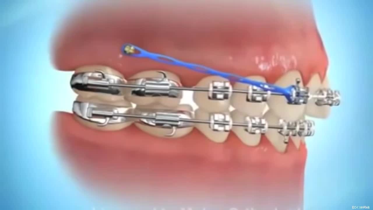 牙齿矫正中的骨钉到底有什么作用？
