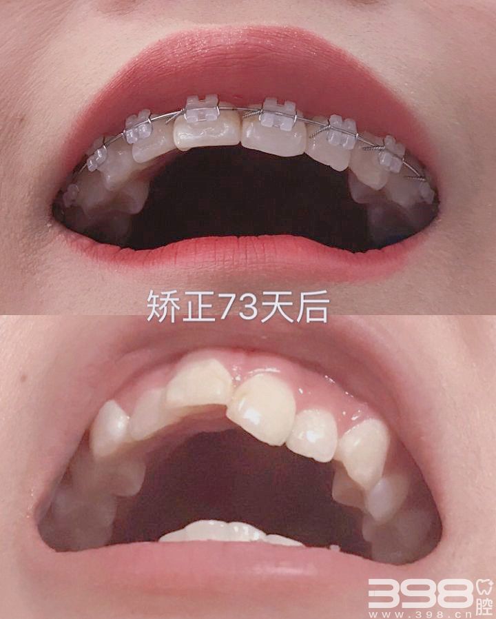 陶瓷牙齿矫正前后对比