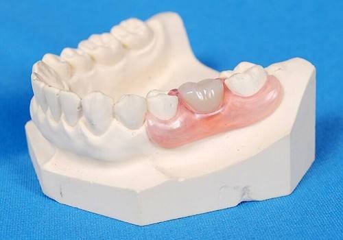 牙齿修复困扰：拔牙后镶牙的最佳时间错过不能镶是真的吗