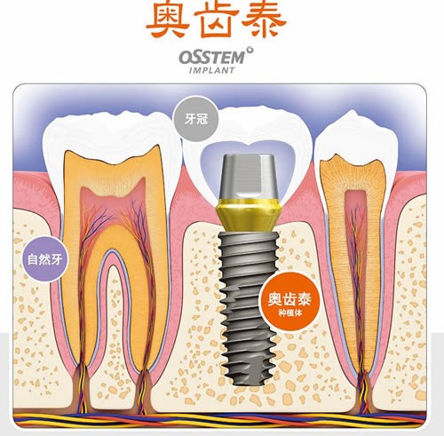 韩国奥齿泰种植牙质量怎么样 来扒扒奥齿泰OSSTEM种牙的缺点