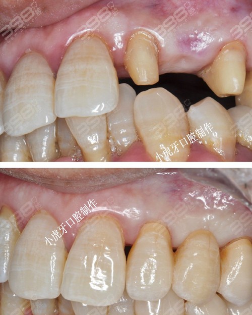 汉中小虎牙口腔全瓷牙修复前后对比照片 全瓷牙能用一辈子