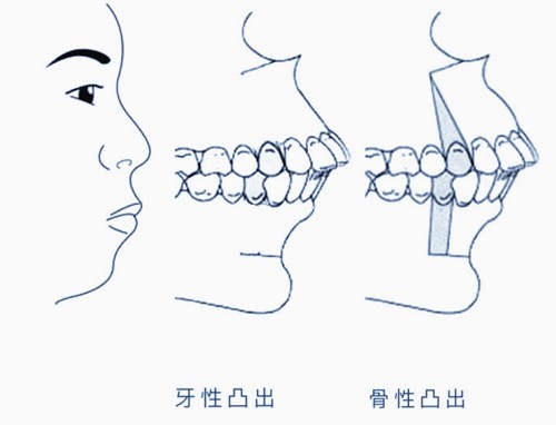 骨性凸嘴正畸：骨性龅牙分几级？牙齿骨性前突怎么矫正？
