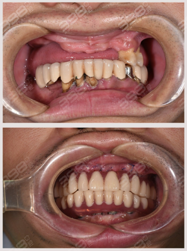 北京all-on-6半口穿颧种植牙技术，让无牙颌患者即刻种植！