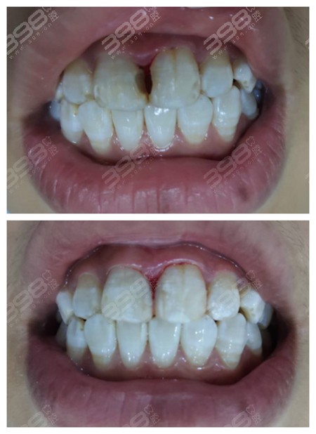 门牙修复用树脂补牙好还是贴面好？有什么区别？