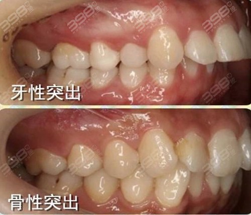 地包天怎么判断是牙性还是骨性？骨性地包天带牙套有效吗