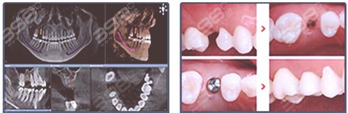 西安林牙立齿口腔门诊部种植牙技术